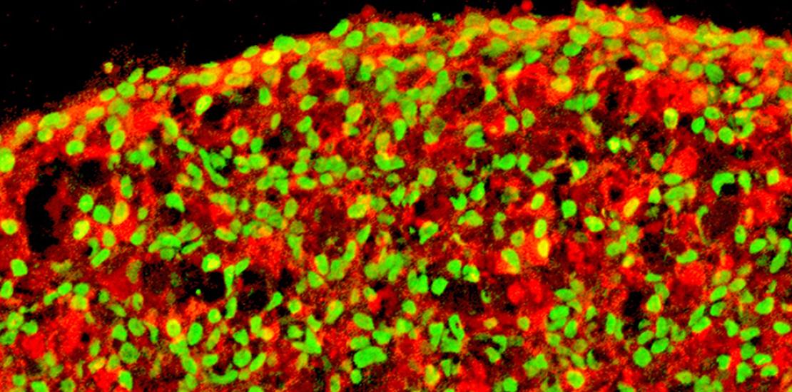 Diabetes Izpisúa UCAM